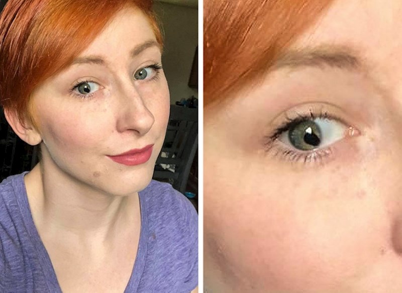 11. "Razlivena" zjenica