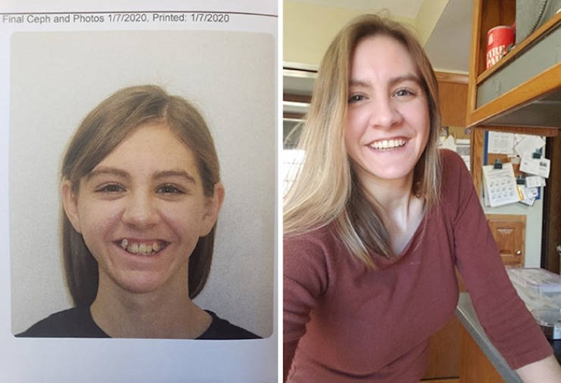 3. Nakon 9 godina nošenja aparatića za zube, napokon je dobila osmjeh iz snova!