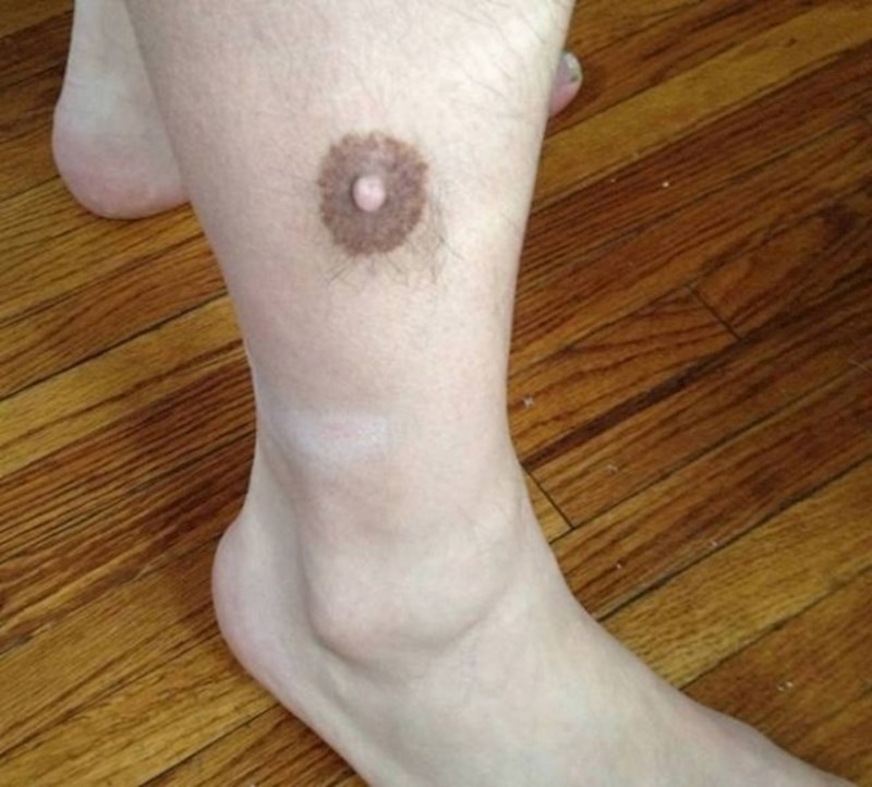 3. Ima bradavicu na nozi...