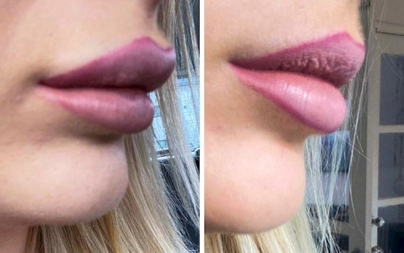 7. Usnice par mjeseci nakon što se hijarulon razgradio.