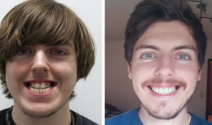 23 ljudi kojima je aparatić za zube potpuno transformirao izgled