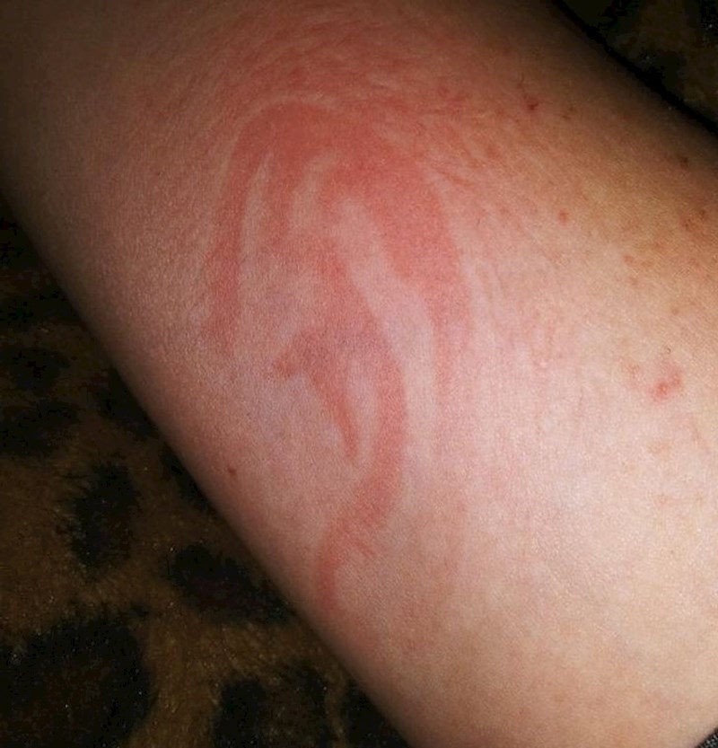 4. Netko je zaspao dok mu je glava bila naslonjena na ruku, pa mu je ostao ovaj smiješan otisak uha😂