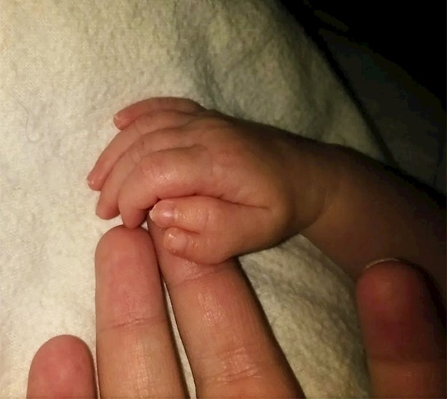 23. "Naša kćerka rođena je s dva palca."