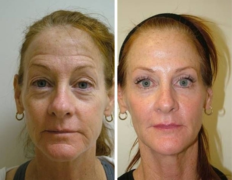 "Ovaj rezultat postigla sam bez estetskih korekcija, samo uz facijalne vježbe."