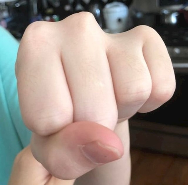 10. "Mojoj kćeri fali kost iznad prsta, ali to joj uopće ne smeta!"