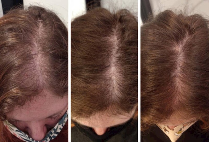 4. "Otkrila sam ulje za rast kose koje mi jako pomaže u borbi s alopecijom i obožavam gledati fotke napretka!"