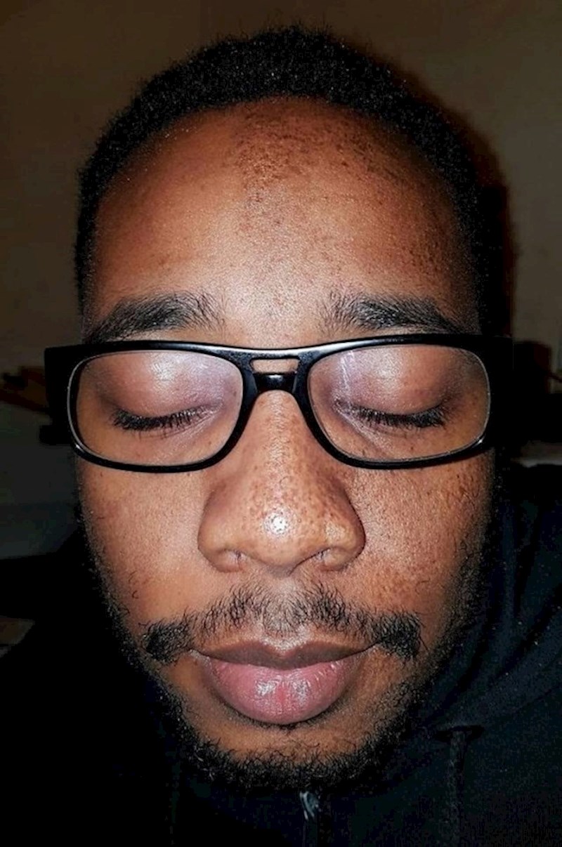 7. Ima pjegice samo na jednoj polovici lica