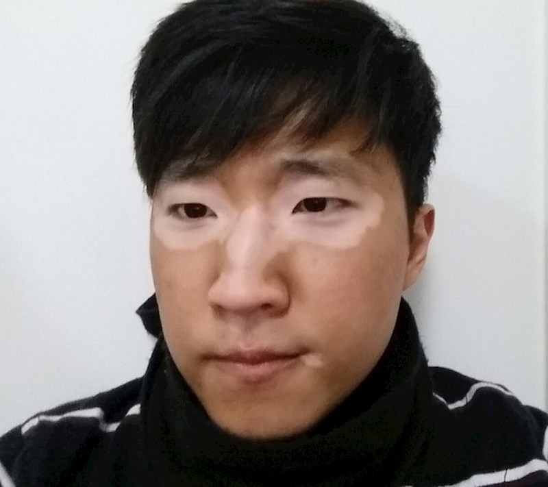 13. Jako simetrične mrlje od vitiliga