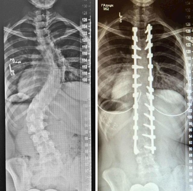 6. "Moja kralješnica prije i poslije operacije."