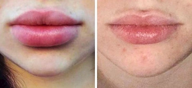 5. Koliko bolje joj usnice izgledaju bez hijaluronskih filera?