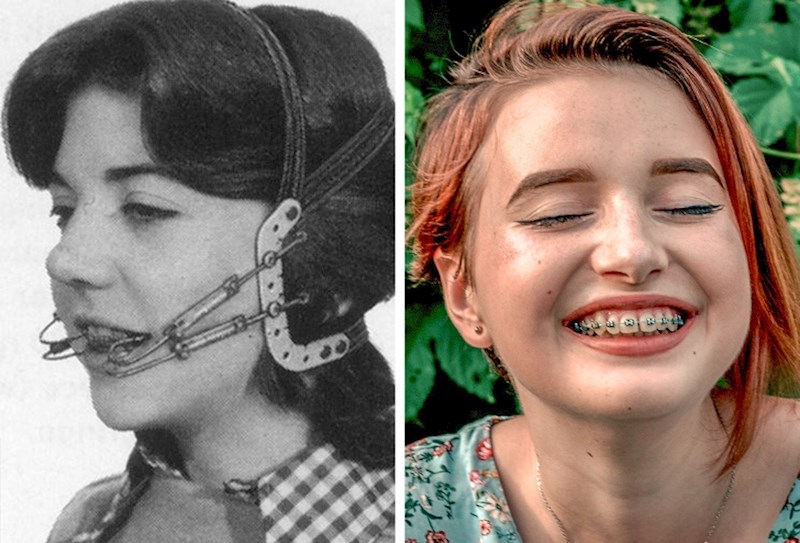 12. Ravnanje zubi u prošlosti bilo je mnogo mukotrpnije.