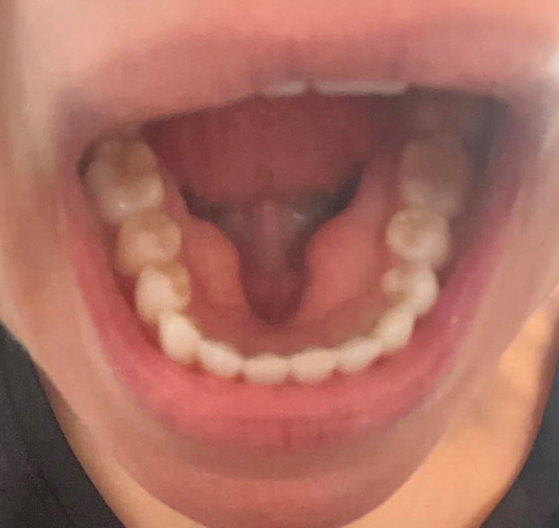 13. Ima rupu ispod jezika