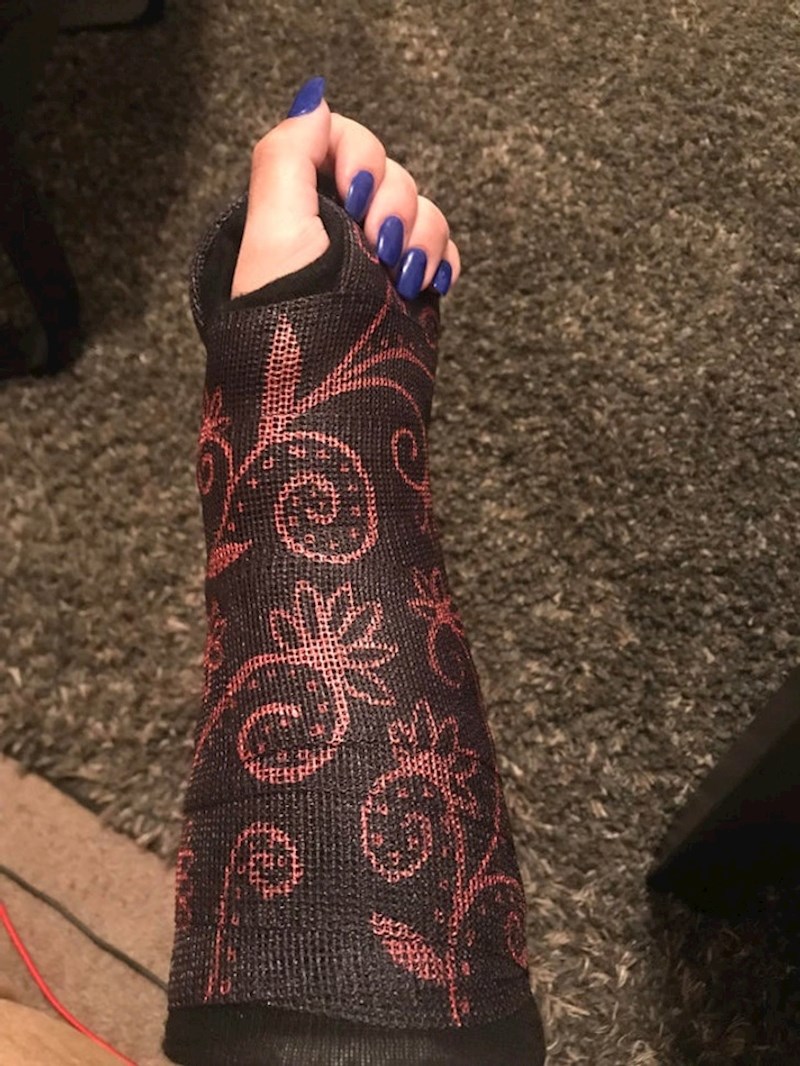 4. Pretvorila je slomljenu ruku u zanimljiv modni dodatak