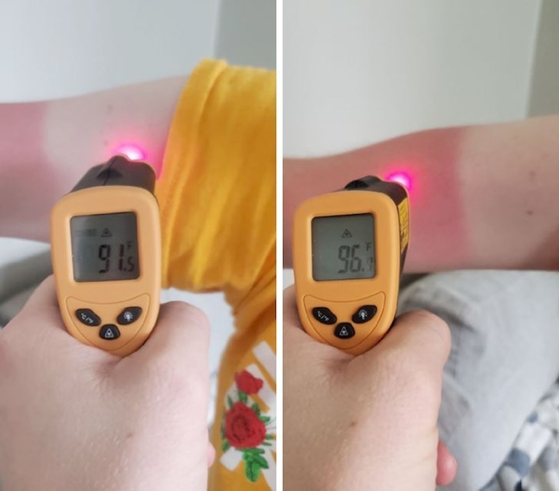 4. Temperatura tijela normalne osobe i temperatura tijela osobe kojoj je izgorila koža.