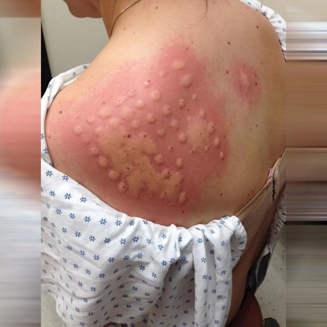 Ono kad imaš alergiju na alergijske testove.