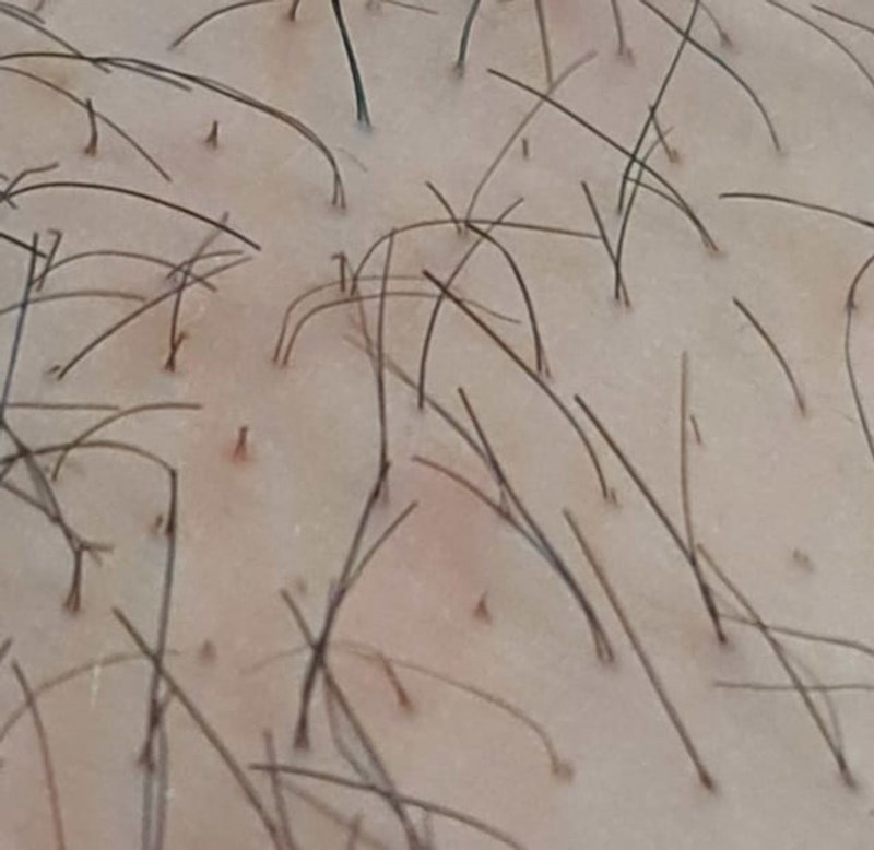 9. “Imam rijetko stanje koje se zove pili multigemini zbog kojeg raste više pramenova kose po folikulu na cijelom tijelu!”