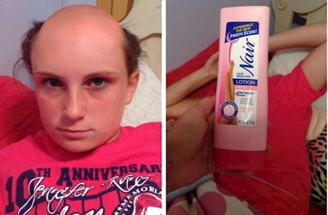 5. Djevojčica koja je ostala bez kose jer je zamijenila šampon i sredstvo za uklanjanje dlaka.