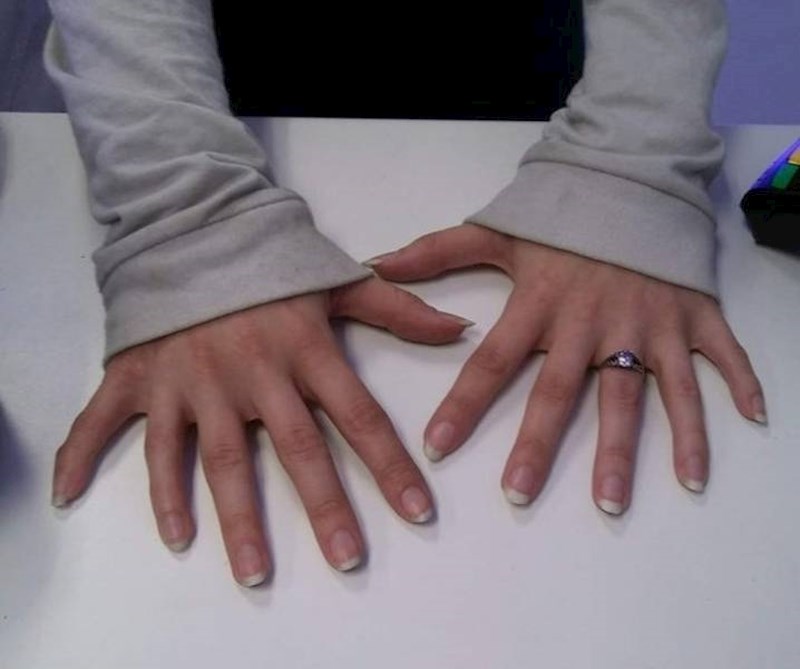 Šest prstiju na svakoj ruci.