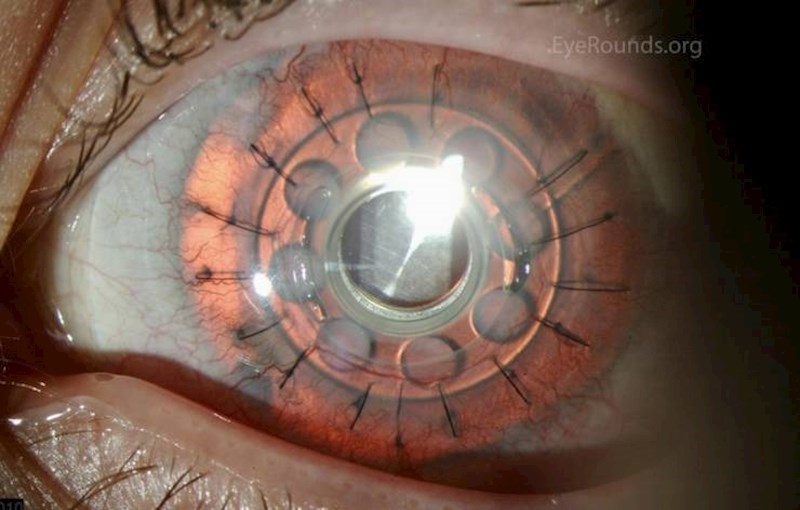 13. Ovako izgleda transplatacija šarenice