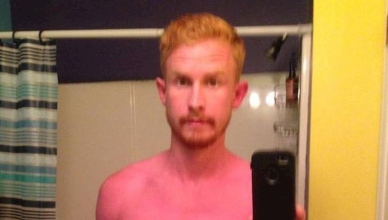 14. Nije stavio kremu za sunčanje