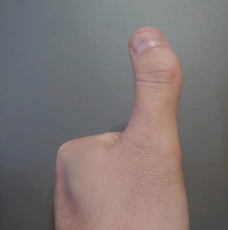 3. Zakrivljeni palac