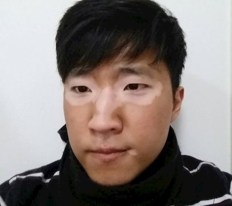 7. Jako simetrične mrlje od vitiliga