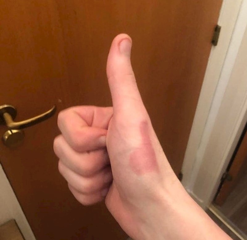 6. Opeklina koja izgleda kao položaj njegovog palca