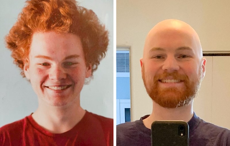 2. Izgubio sam kosu zbog kemoterapije i nikad više nije narasla