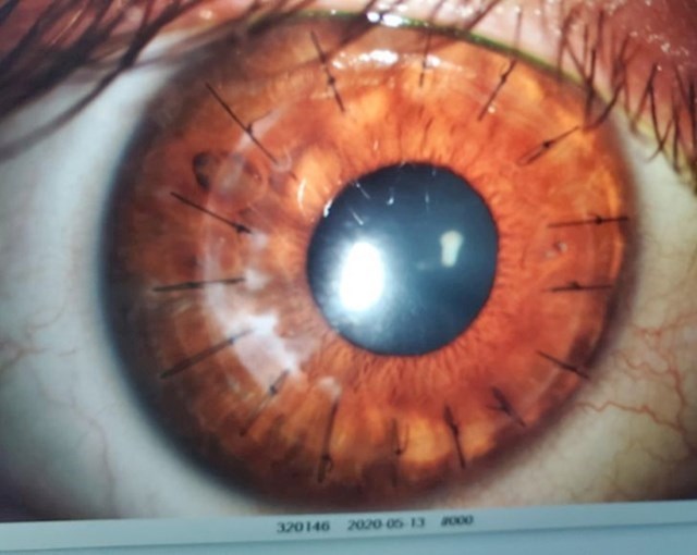 2. Evo kako izgledaju šavovi u oku.