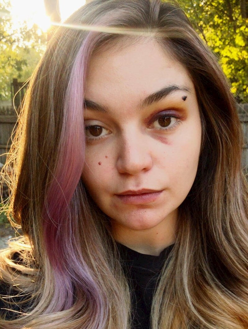 13. "Ofarbala sam pramen kose i sljedeći dan pala na lice. Sad imam modricu koja pristaje uz pramen."