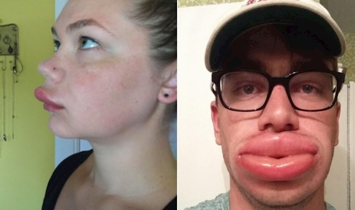 20+ fotki ljudi koji su zahvaljujući ubodima pčela dobili besplatno povećanje usana
