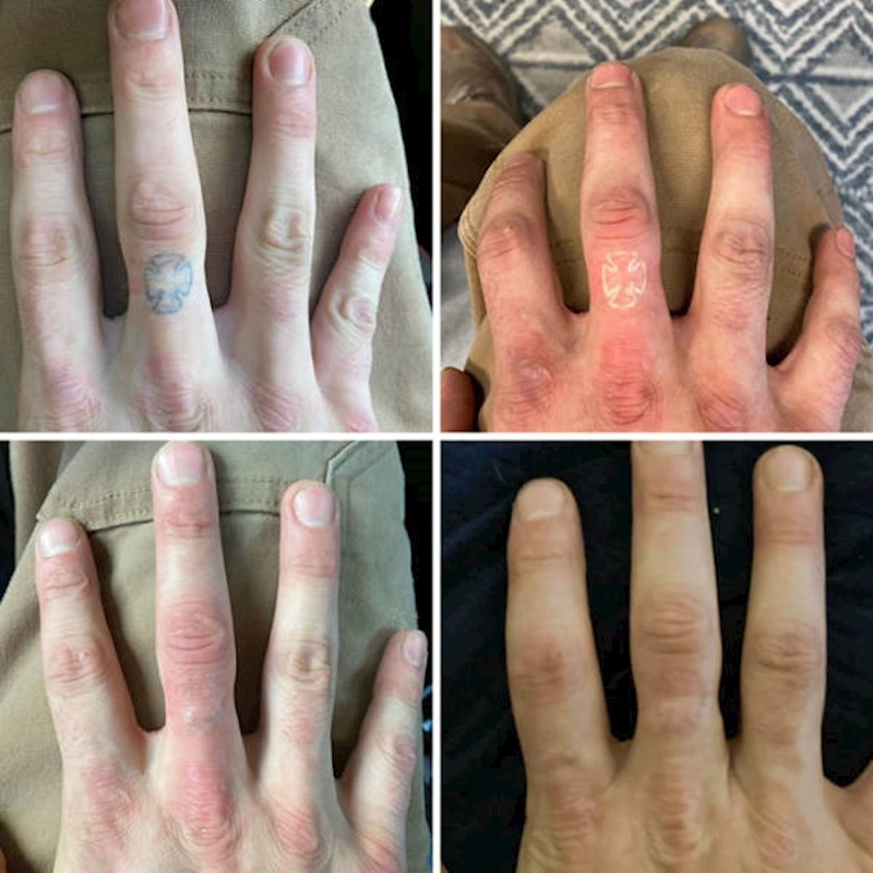 5. Proces uklanjanja tetovaže