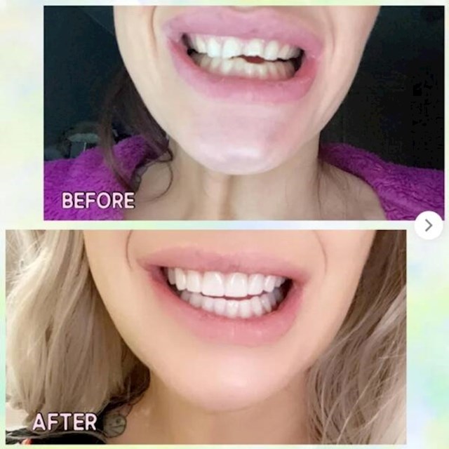 8. Djevojka prije i nakon posjeta zubaru