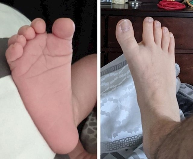 1. Beba je naslijedila veliki razmak između prstiju