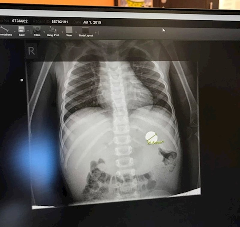 16. "Moj sin je pojeo novčić."