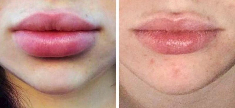 5. Koliko bolje joj usnice izgledaju bez hijarulonskih filera?