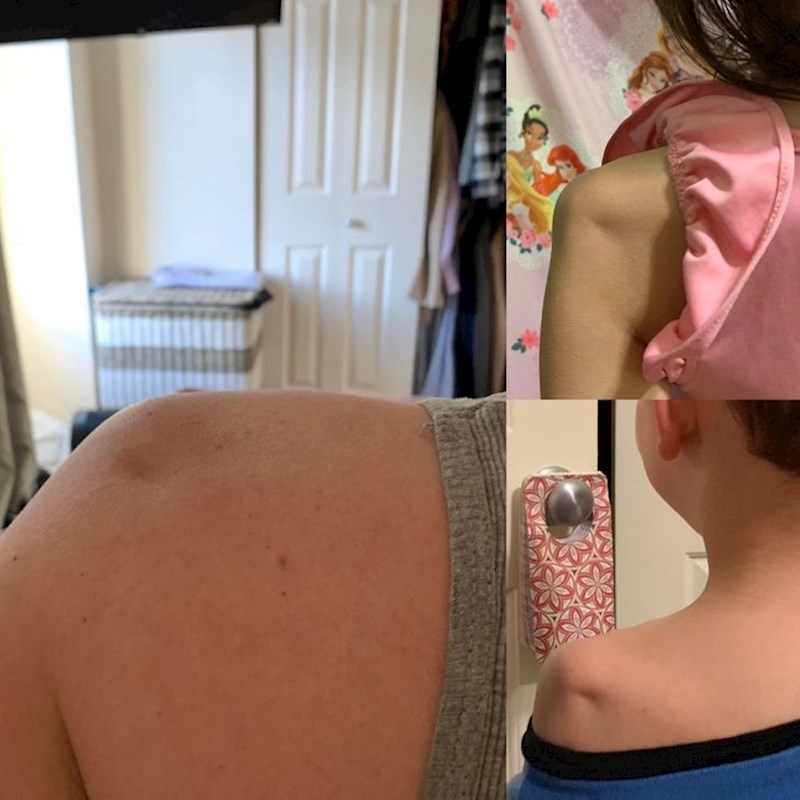 18. Moj muž, djeca i ja - svi imamo ove udubine na ramenima