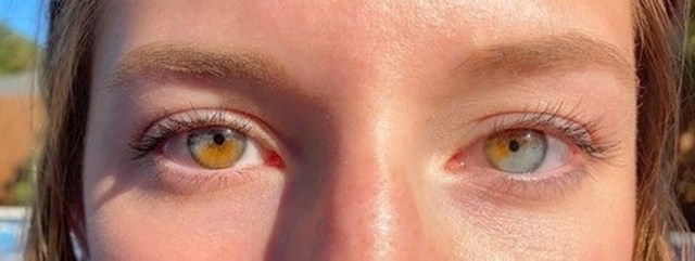 3. Ima heterokromiju na oba oka