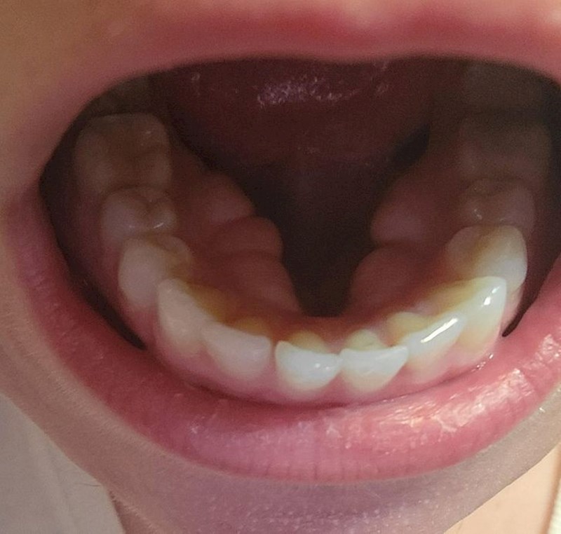 3. Osoba koja u ustima ima malo previše kostiju.