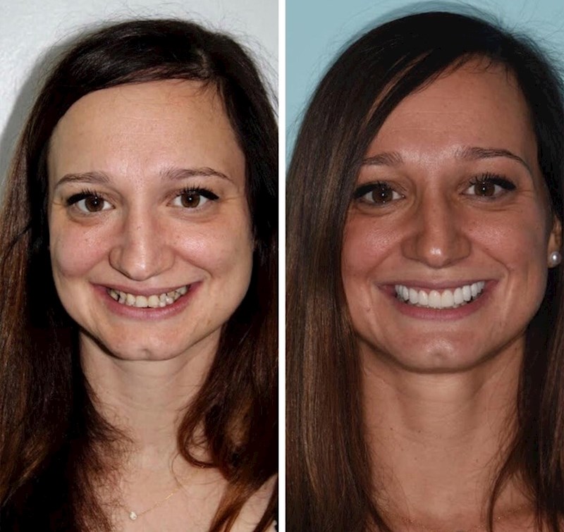 "Nakon par mjeseci vježbanja, zubnih ljuskica i brige o sebi."