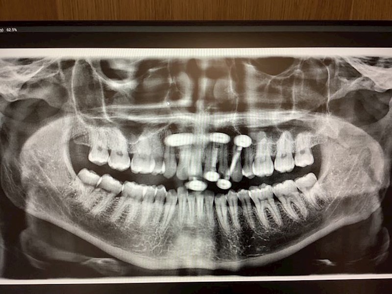 13. Snimka osobe koja ima 3 pirsa na jeziku