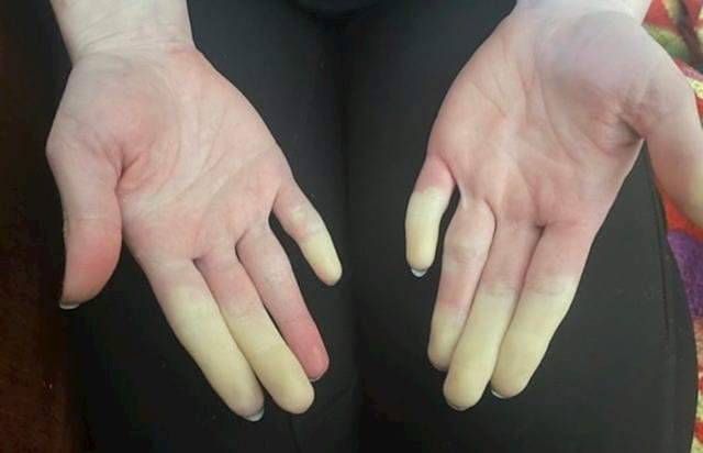 5. Ruke osobe s Raynaudovim sindromom