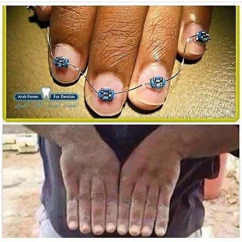 Kako izravnati prste