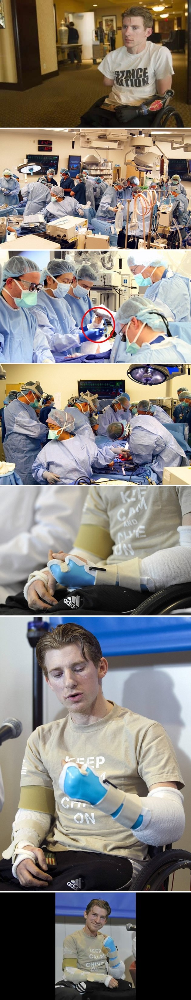 Transplantirali mu obje ruke!