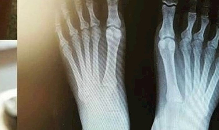 Otišla je napraviti rendgenske slike stopala, doktor se smijao kad je vidio jedan detalj