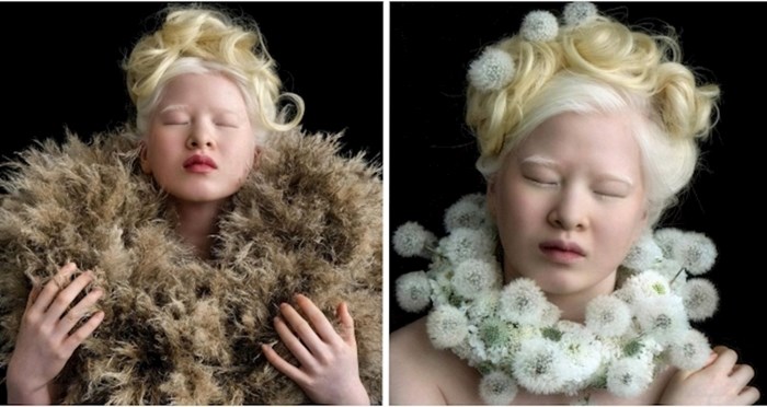 Albino djevojčica koja je napuštena kao beba, danas je Vogue model