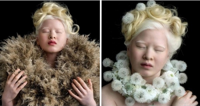 Albino djevojčica koja je napuštena kao beba, danas je Vogue model