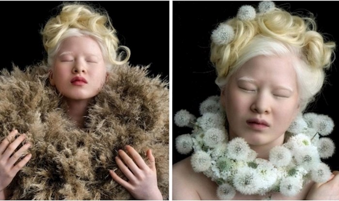 Albino djevojčica koja je napuštena kao beba, danas je Vogue model