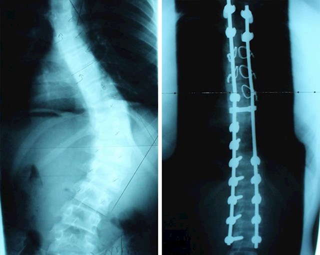 #12 Rendgenski snimak leđa, prije i nakon operacije zbog skolioze