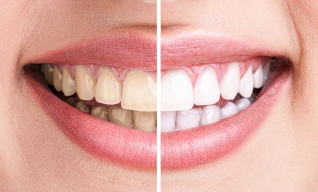 6. Bijeli zubi pokazatelj su zdravlja.